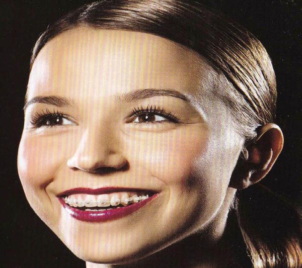 GBDental - Félesztétikus önligírozó 